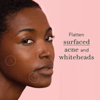 Salicylic Acid Acne Patch