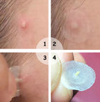 Acne stickers