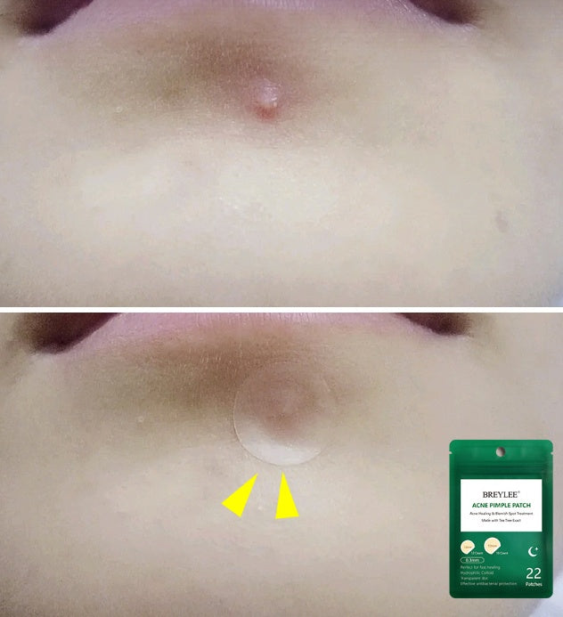 Acne stickers